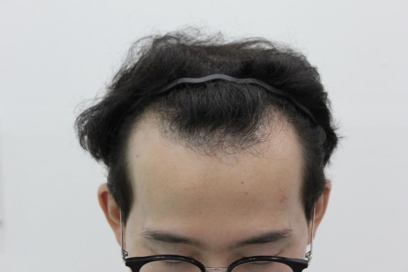 광주 압구정 모비앙 비절개 무삭발 6개월 후기 입니다.