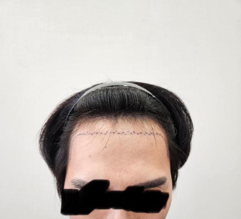모재성에서 2200모낭(4400모) 비절개 1일차 후기입니다