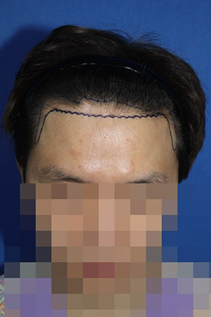 모발이식 1년차 기록. 잘된 것 같나요?