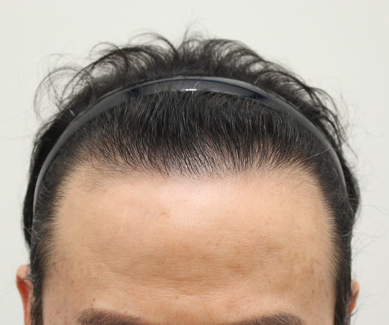 9.수술9개월째.jpg