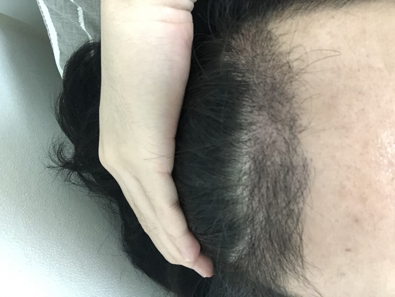 뉴헤어 절개 4개월차입니다.