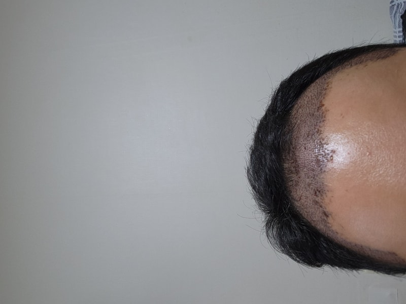 모우림 의원 수술후기 결과입니다
