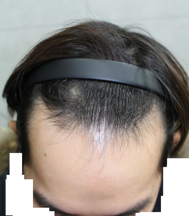 모발이식 절개 3300모 수술 전, 라인, 직후 사진