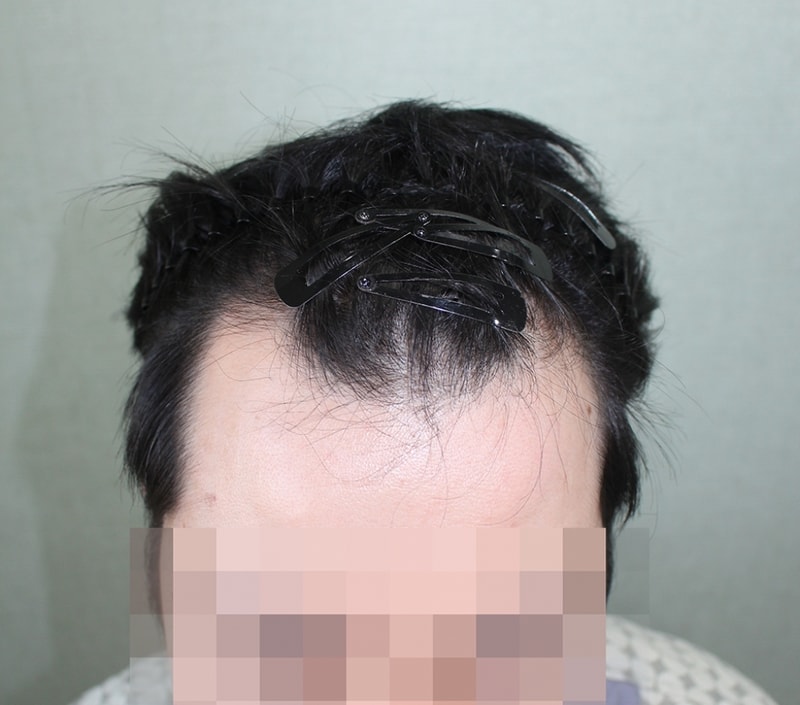 초기M자 고민 끝에 절개 2750모 이식 받았어요