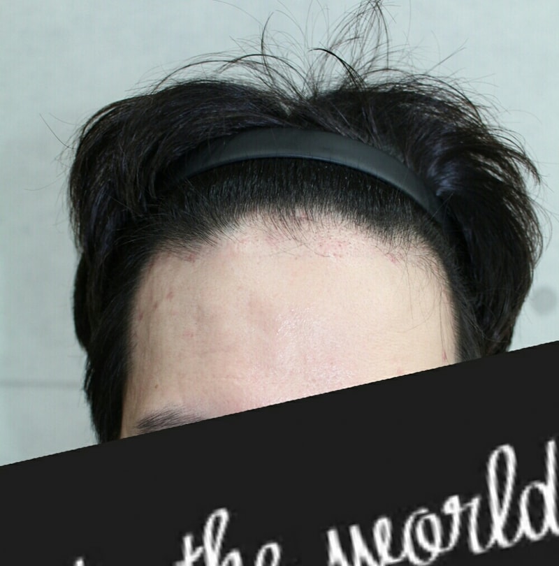 Two months of transplantation to clean up the hairline