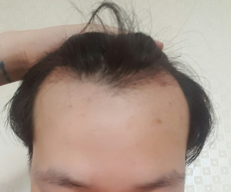 ㅍhh, it's the second month of the 1200 follicle surgery