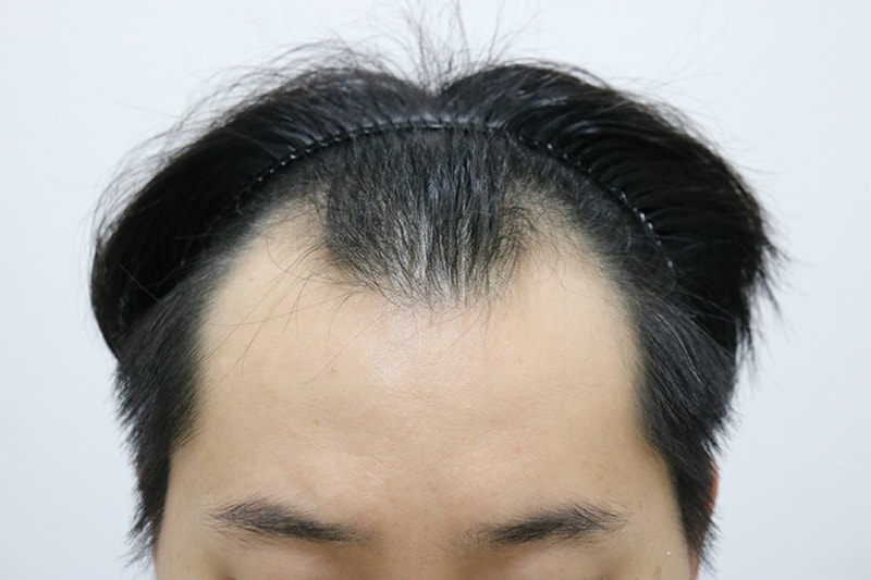 M자 모발이식 비절개 3개월 지난 후기