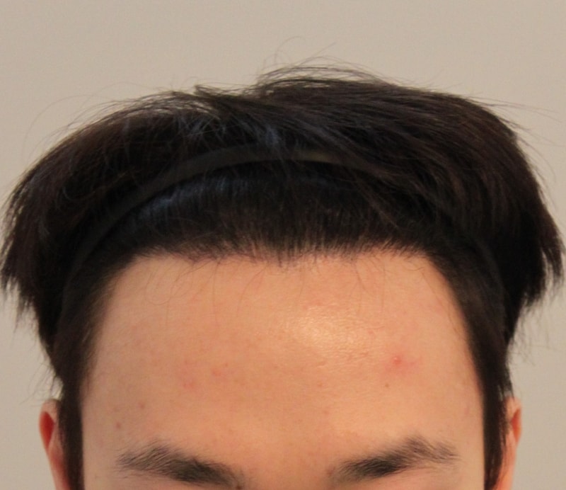 포헤어 팔개월 정리
