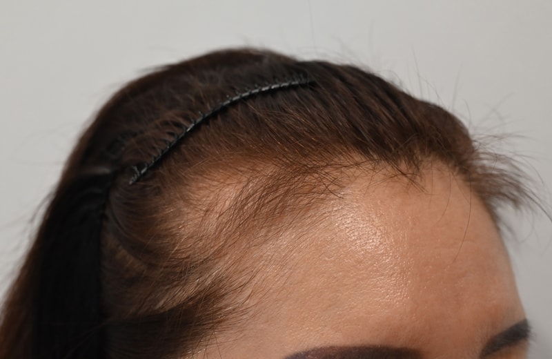 Non-cut Hidden Cut Hairline Hair Transplantation 2200 Mo The Day After