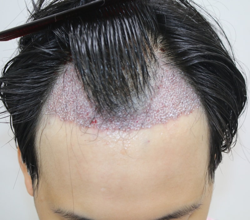 수술후1.JPG