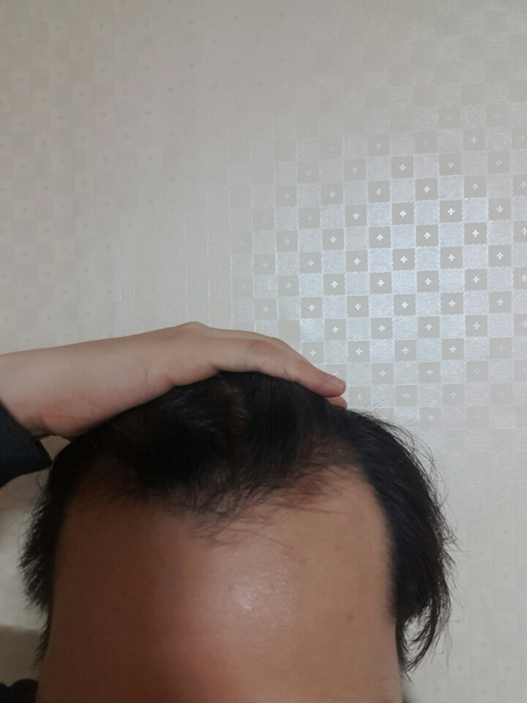 ㅍㅇ후기 1200 follicle surgery review