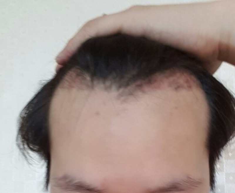 ㅍYes, it's been a month since I had 1200 follicle surgery