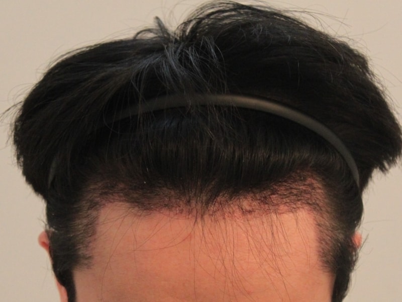 M자 수술 1200모낭 한달차 괜찮나요?