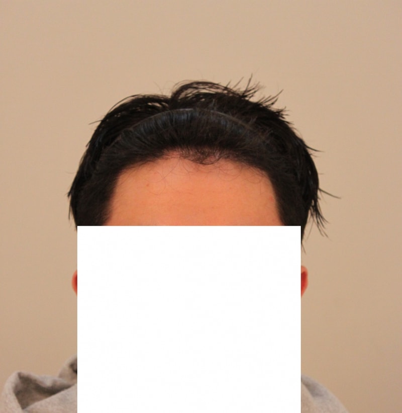 M자 수술 1200모낭 반년이네요