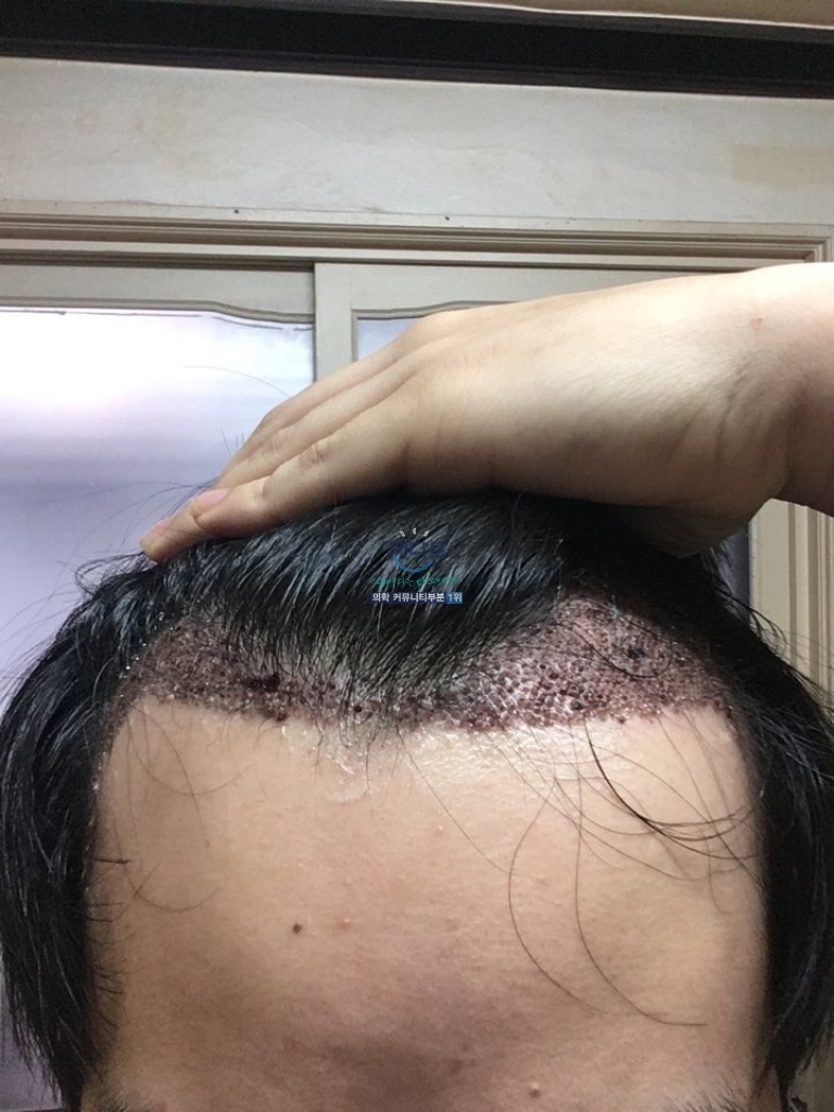 M자 탈모 1300모낭 암흑기 입니다...