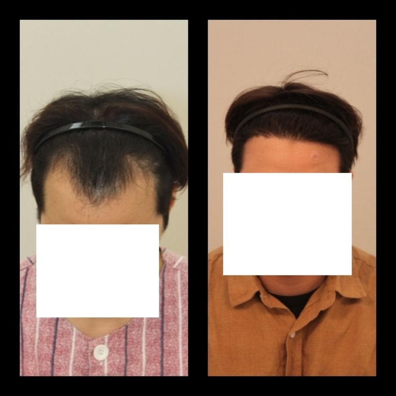 포헤어 1400모낭 1년됬네요
