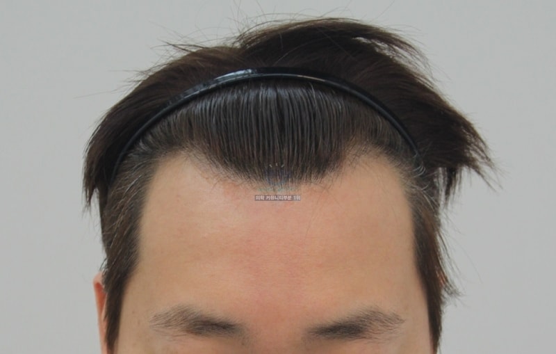 포헤어에서 모발이식한지 반년 됐습니다.