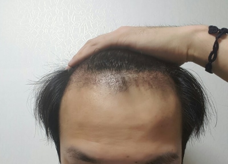 수술후2개월2.jpg