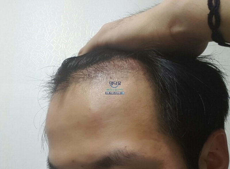 발모중1.jpg
