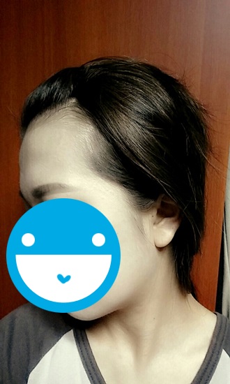 포헤어 헤어라인교정 1년 지났어요!