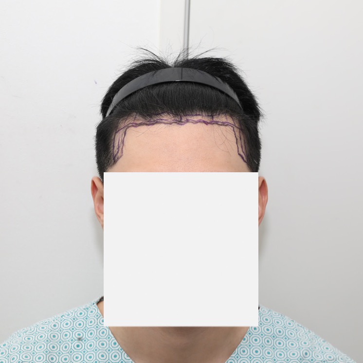 비절개 헤어라인 시술했습니다