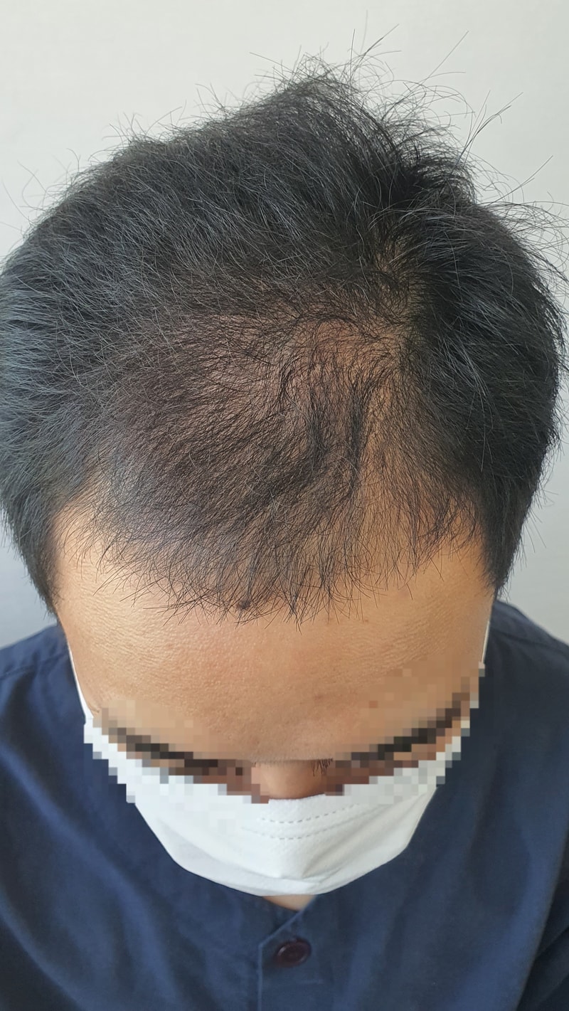 드디어 1년차입니다. 비절개 2250모낭