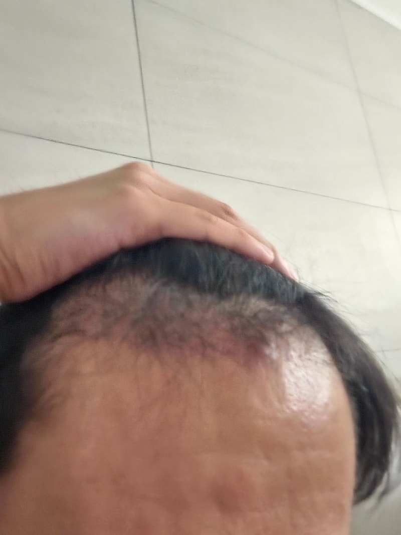 모발이식 3개월차 후기