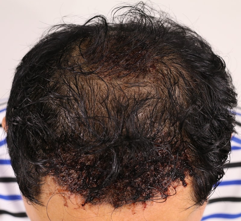 압구정 모우림의원에서 모발 및 눈썹이식 후기