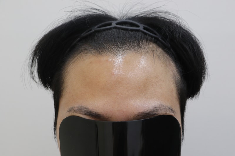 광주압구정모비앙의원 모발이식 1년경과 후기