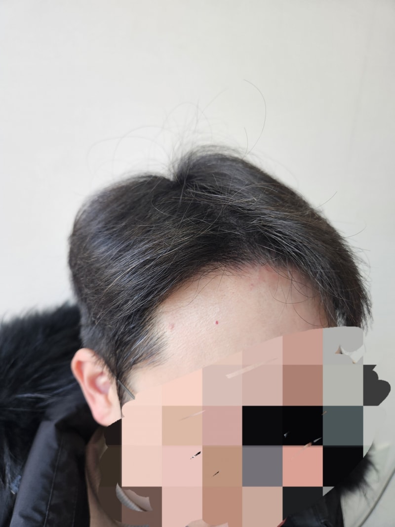 늦은 모발이식 8개월차 후기