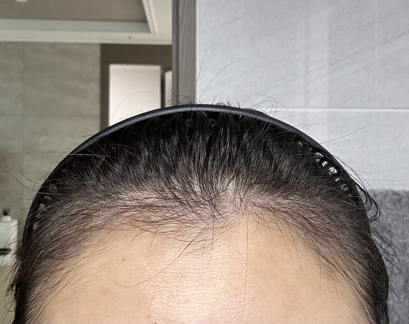 뉴헤어부산의원 수술 후 3개월 경과입니다~