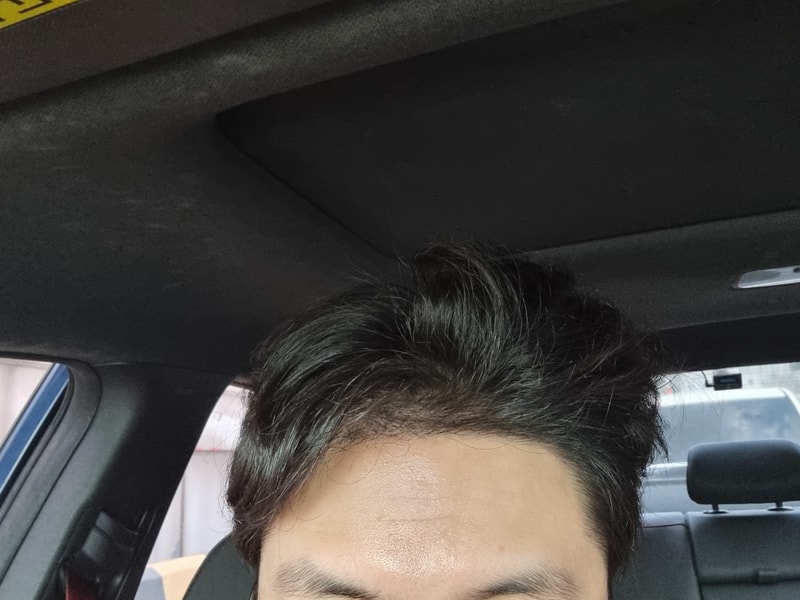 2200모낭 4~5개월차 경과