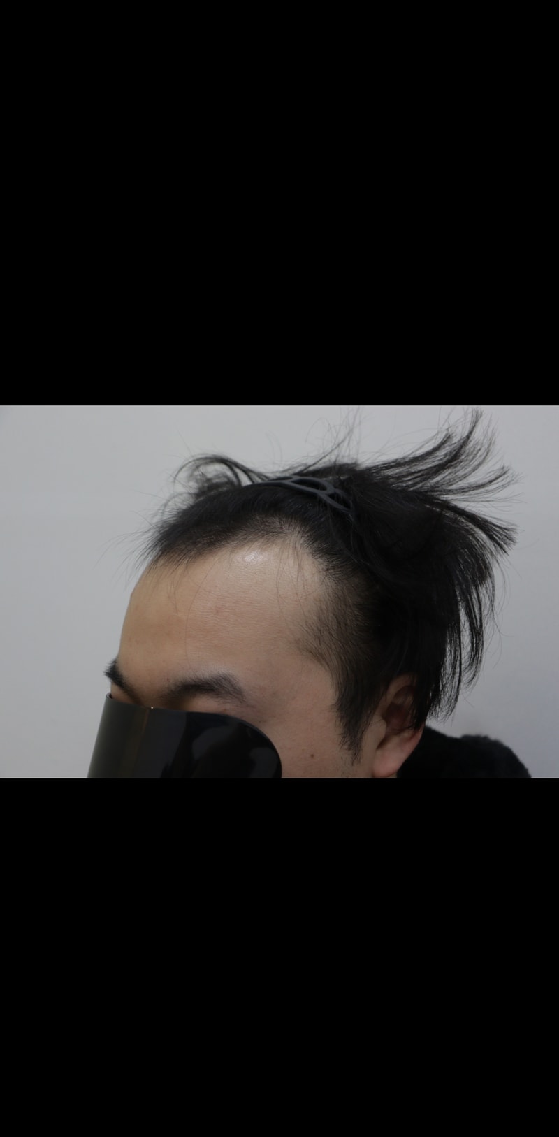 광주 압구정모비앙 의원 모발이식 10개월 경과후기