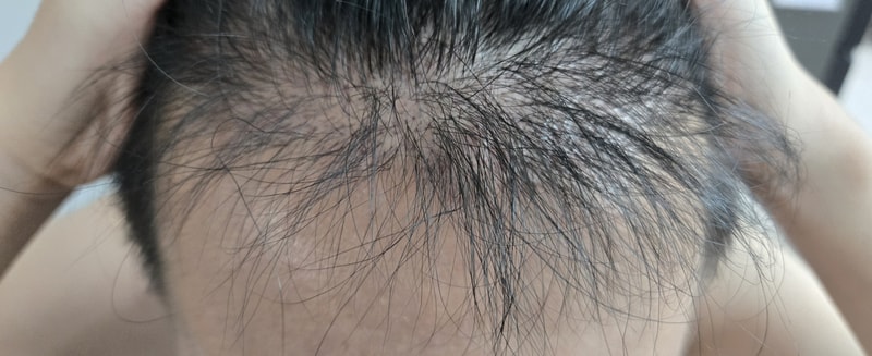 뉴헤어 모발이식 3600모 6개월차 후기
