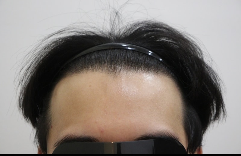 광주 압구정 모비앙 의원 비절개 삭발 1년 경과 후기