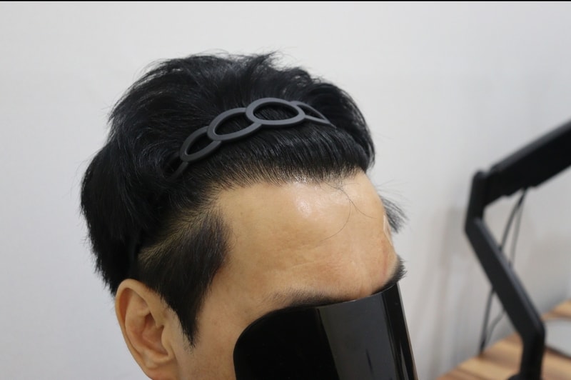 광주압구정모비앙의원 모발이식 1년경과후기