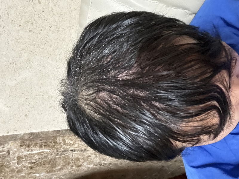 Day 2 after non-cut/uncut 1300 hair follicle surgery