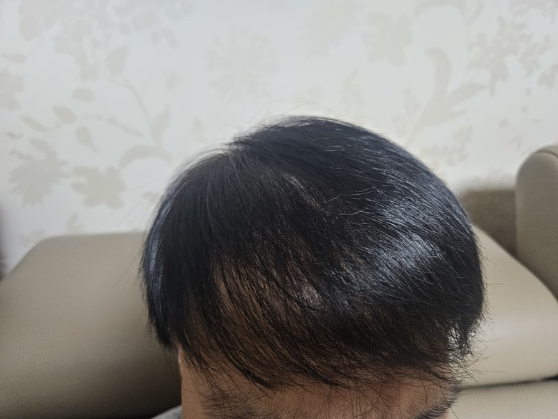 모재성 모발이식 3000모 1년 후기