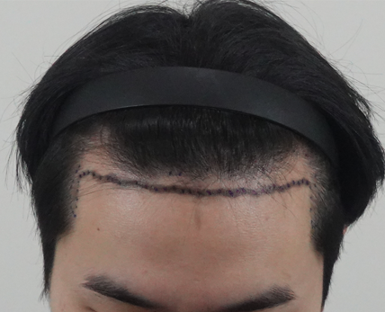 용닥터 김용빈 원장님 비절개모발이식 6개월차요