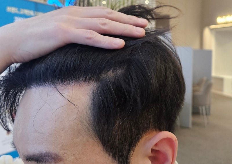 ニューヘアソウル店 非切開 植毛 1200株 10ヶ月目です