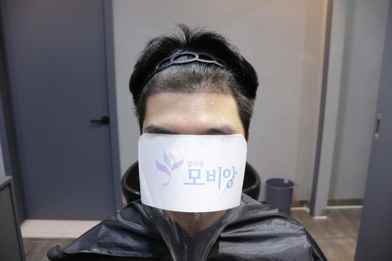 Gwangju Apgujeong Mobiang Hair Transplantation 2nd Week Review