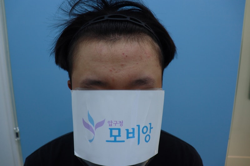 광주압구정 모비앙의원 모발이식 1년경과 후기