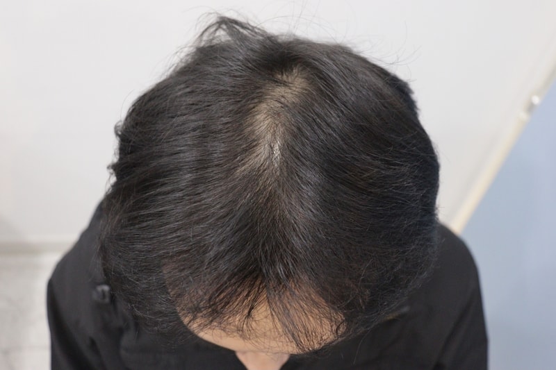 광주압구정모비앙의원 모발이식 10개월경과 후기