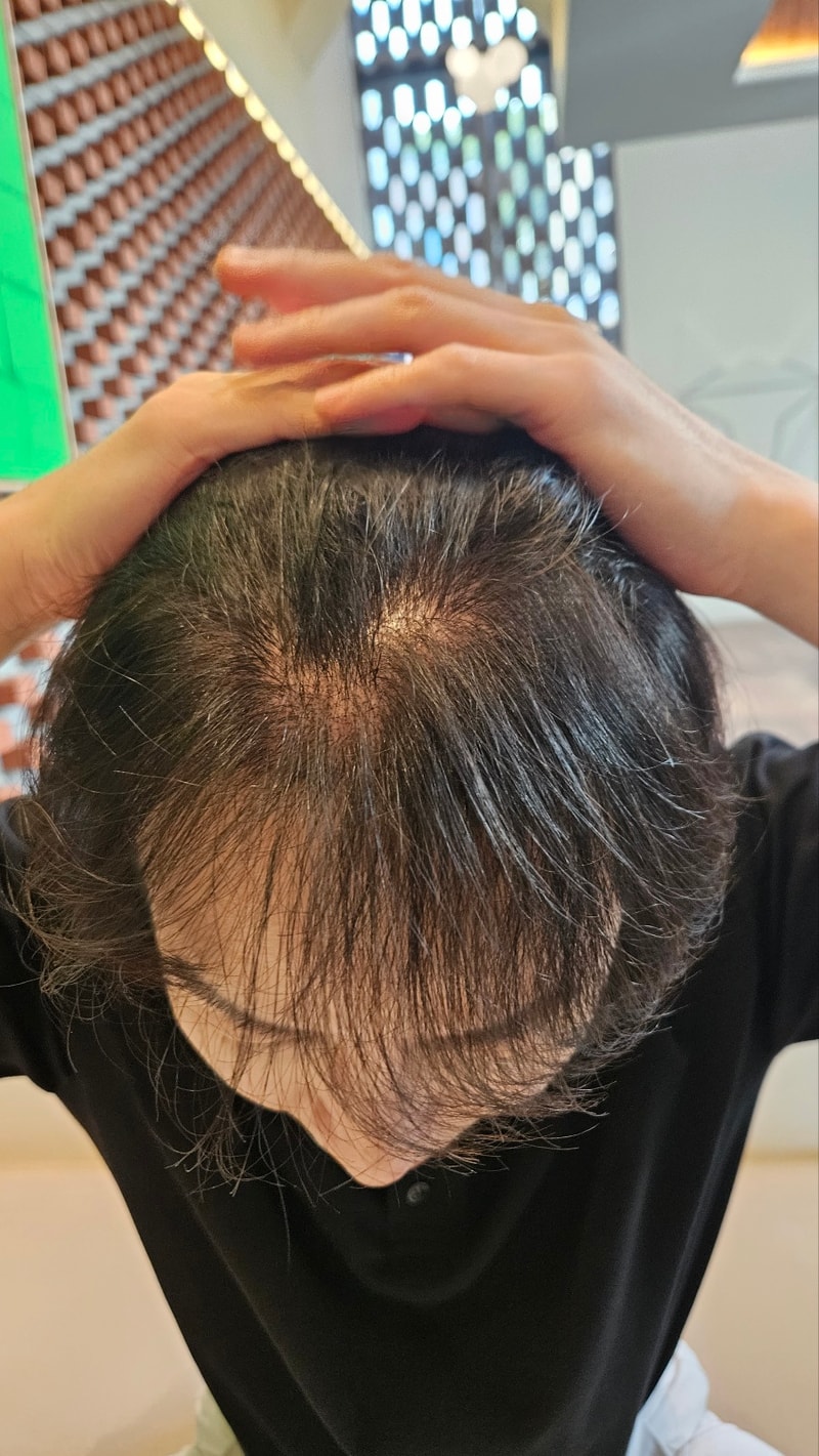 ニューヘアソウル店非切開植毛1200株1年1ヵ月目です