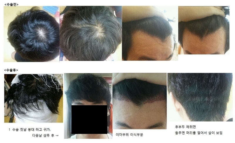 모발2.png