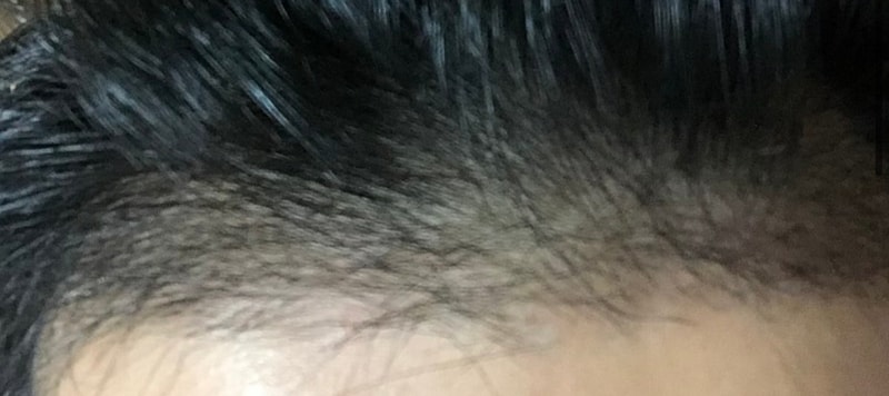 다나 비절개 무삭발 4개월차