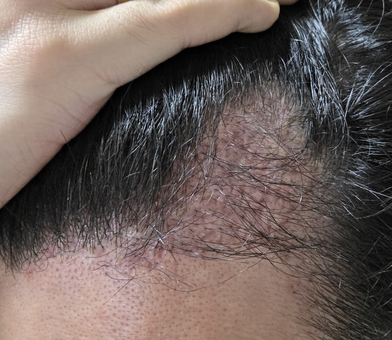 Day 80 of post-mortem hair transplant surgery
