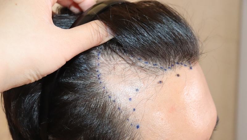 Umchan Hair Transplantation Consultation~ 6th day after surgery (true review)