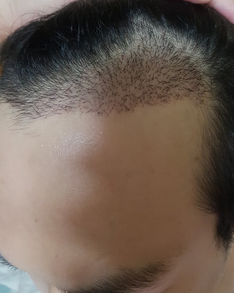 딱지제거후 좌.jpg