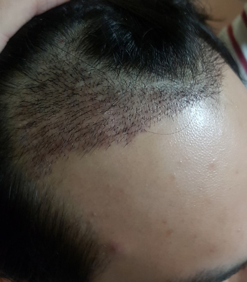 딱지제거후 우.jpg